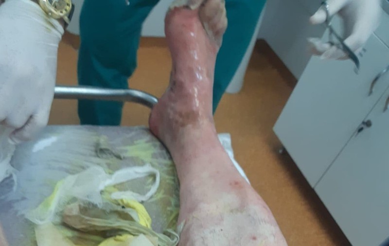 Cazanul cu țuică a explodat într-un sat din Vaslui, iar un bărbat a fost grav rănit