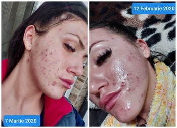 Așa arăta tenul Alexandrei, după ce a folosit produsele Plush Bio