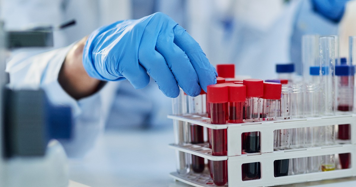 Imaginea, realizată într-un laborator, surprinde o mână protejată de o mănușă albastră care manipulează eprubete cu dop roșu ce conțin mostre de sânge. Eprubetele sunt așezate într-un suport de plastic pe o masă luminoasă, alături de alte eprubete cu dop albastru.