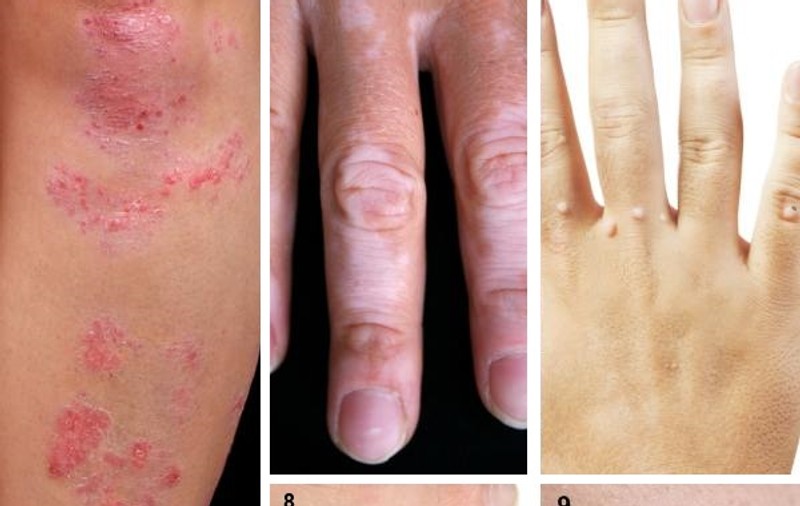 Cât de contagioase sunt, de fapt, bolile de piele?