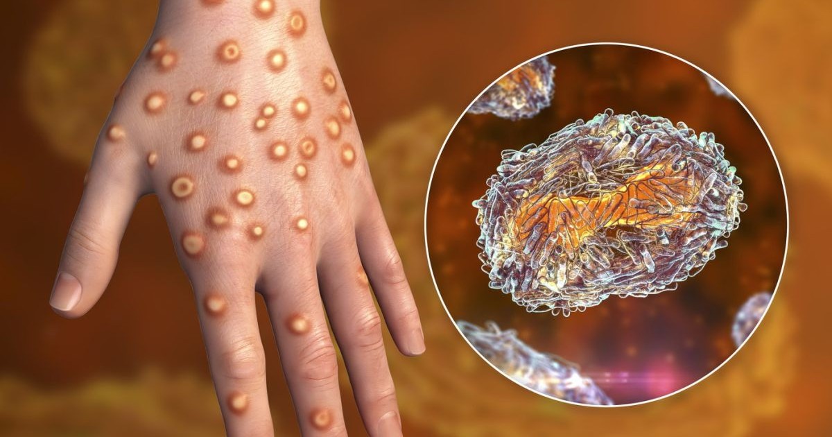Mâna unui pacient cu infecție cu variola maimuței și vedere de aproape a particulelor de virus mpox, ilustrație pe computer.