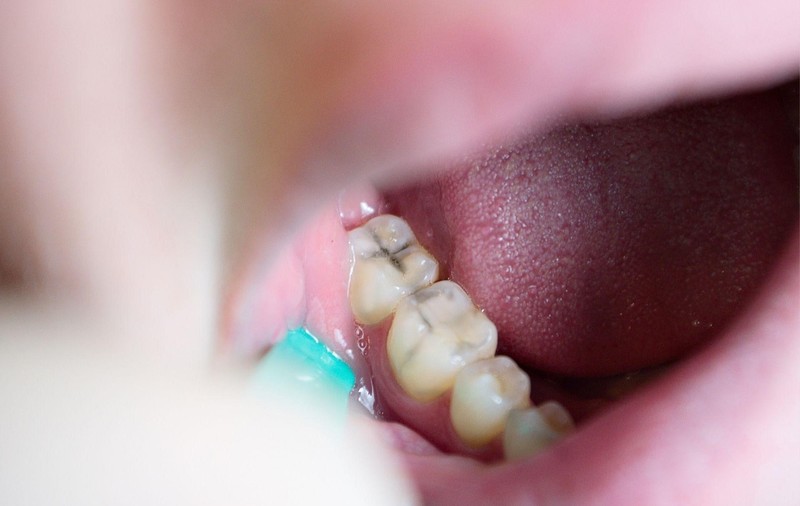 Revoluția Materialelor Ceramice în Estetica Dentară Modernă