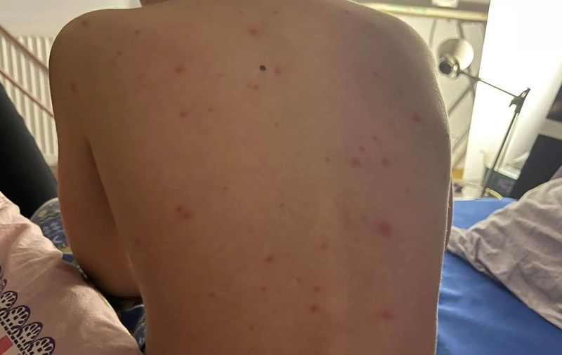 Epidemie de varicelă în județul Alba: Numărul cazurilor a explodat în luna noiembrie