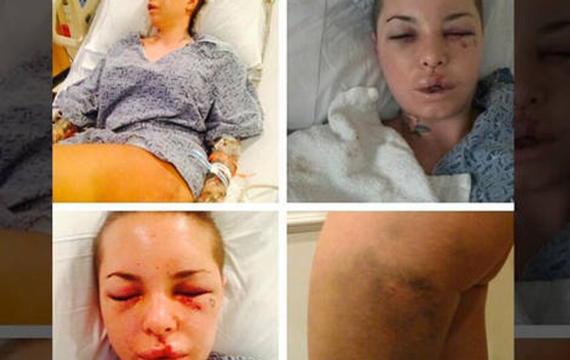 DESFIGURATĂ în BĂTAIE de fostul iubit, actriţa de filme XXX Christy Mack va primi operaţie de RECONSTRUCŢIE A FEŢEI GRATIS