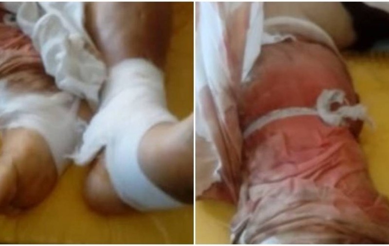 O pacientă a spitalului din Caransebeș, ținută cu pansamente neschimbate câteva zile