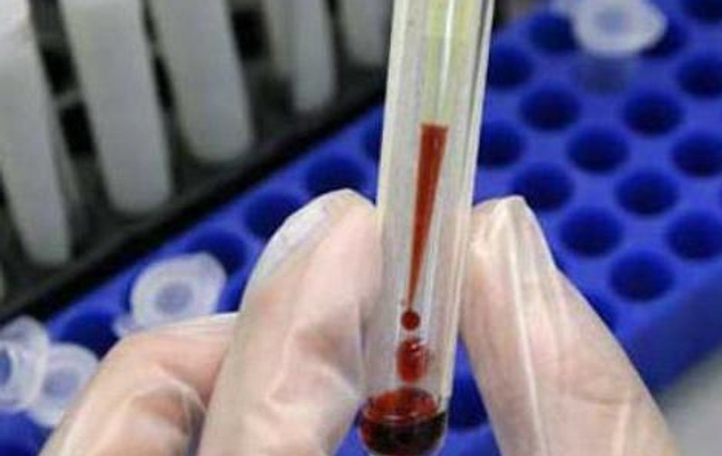 Focar de hepatita A în județul Botoșani
