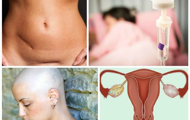 Controlul făcut la timp îți poate salva viața! 1.020 românce pierd anual lupta cu cancerul ovarian