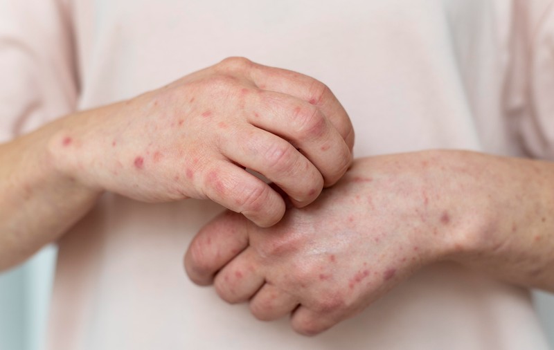Noua variantă de Mpox a ajuns în Franța: „Acest lucru necesită vigilență și prudență”