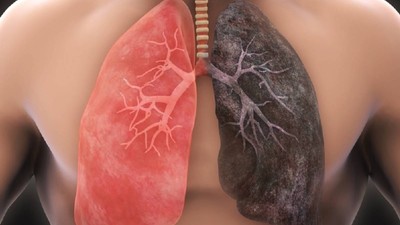 cancer pulmonar