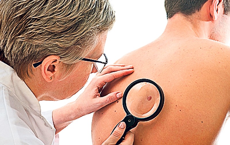 Un nou tratament contra cancerului de piele, în teste