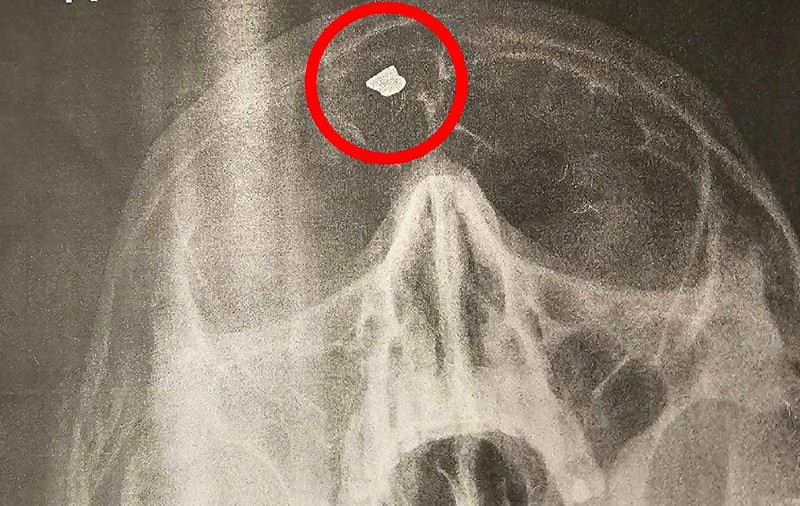 Bărbatul care trăia de 40 de ani cu un glonț în cap și nu știa: „Ne jucam de-a Wilhelm Tell, fratele meu a țintit un măr pus capul meu, a ratat și m-a împușcat”