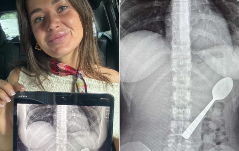 O femeie din Belgia a înghițit o lingură de 17 cm în timp ce mânca iaurt, după ce câinele ei i-a sărit în poală: „Nu mă simțeam deloc rău”