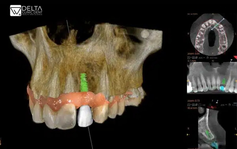 Igiena orală după implantul dentar. TOT ce trebuie să știi