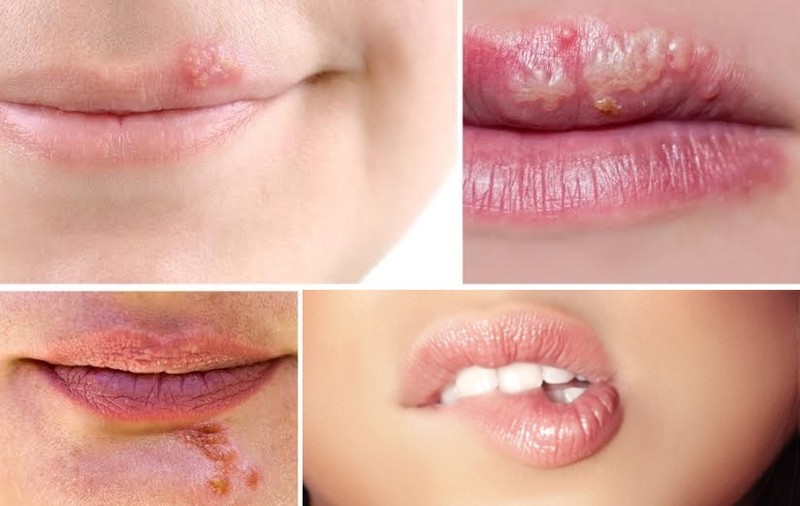 Cum îţi dai seama dacă ai herpes sau zona zoster