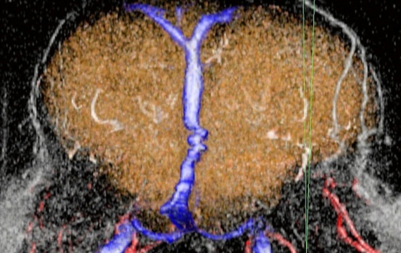 Genele care sporesc riscul de atac cerebral, identificate