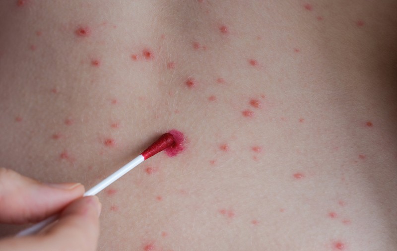Al patrulea deces în România din cauza rujeolei: un copil de 1 an, din Giurgiu, nevaccinat şi cu mai multe comorbidităţi