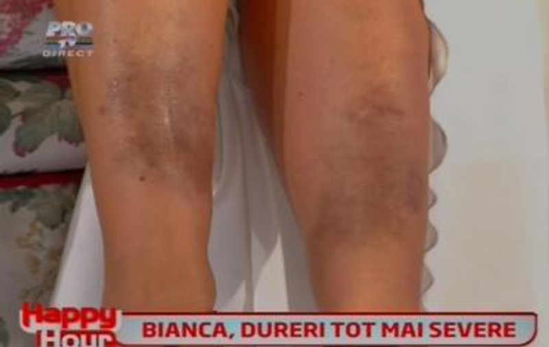 FOTO ȘOC! Bianca are PICIOARELE PRAF din cauza BĂTĂILOR de la fostul iubit! Uite URMELE LOVITURILOR și cum se chinuie ROȘCATA să fie un om normal!