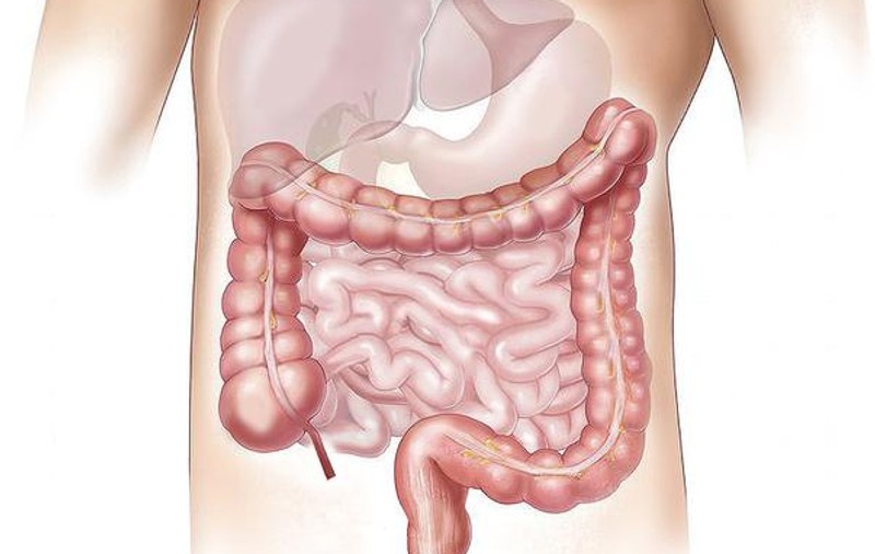 Medicul Alexandru Oproiu: Cancerul colorectal este cauzat de alimentaţia modernă, bogată în carne roşie. Vârsta la care apare boala a scăzut la 45 de ani