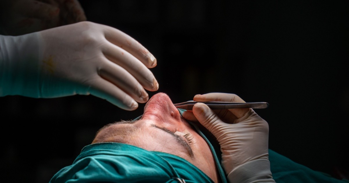 Pacient sub anestezie inainte de operatie rinoplastie