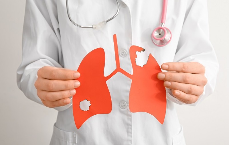 Influența diagnosticului precoce asupra evoluției cancerului bronho-pulmonar