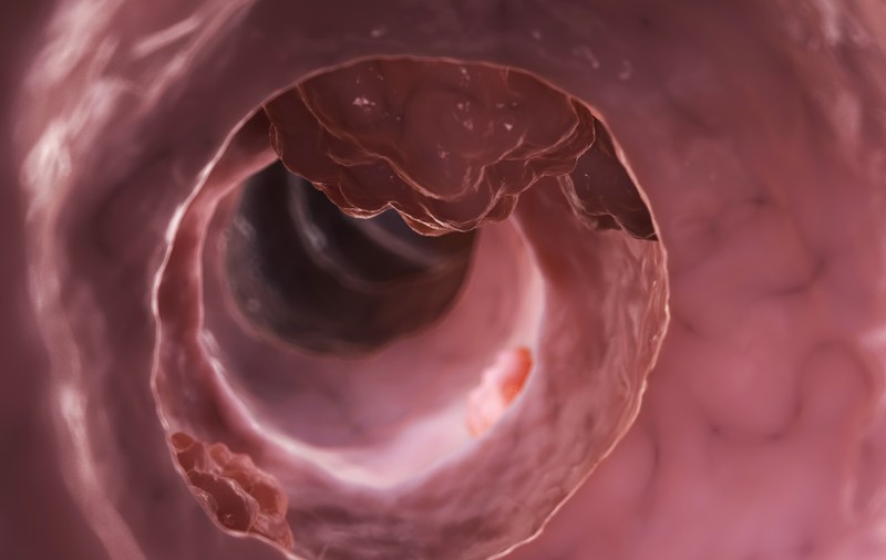 Top 4 factori de risc pentru apariția cancerului gastric
