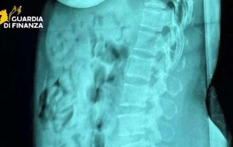 Româncă prinsă într-un aeroport din Italia cu heroină ascunsă în stomac: 120 de capsule descoperite la controlul cu raze X
