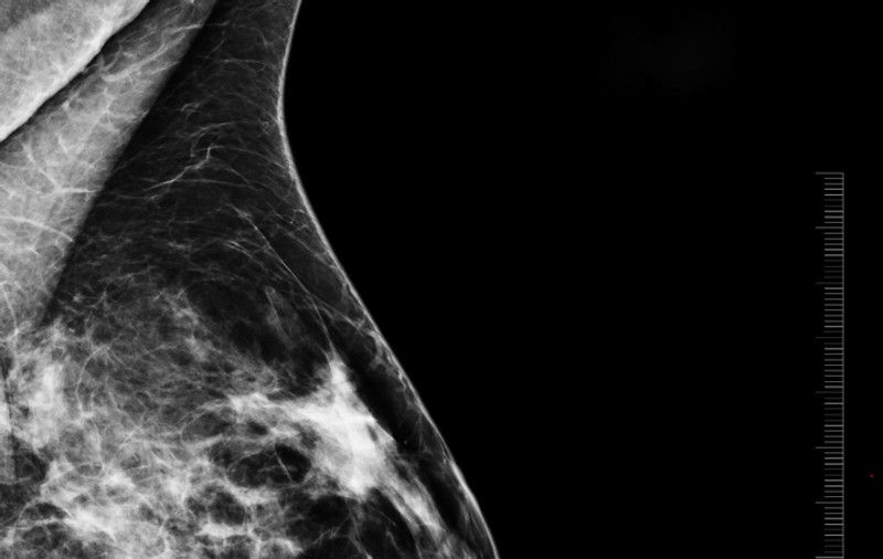 Sănătate: Nodul la sân înseamnă cancer?