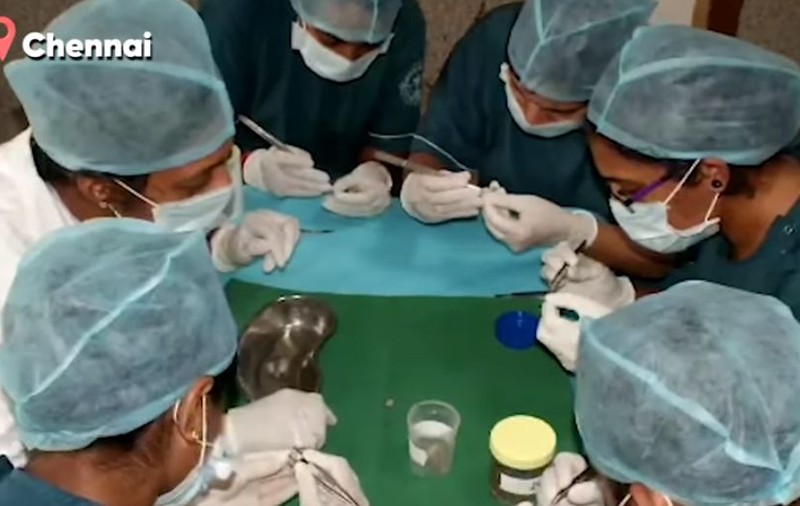 Medicii i-au scos 526 de dinți unui copil din India