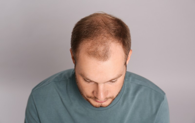 Alopecia - factori de risc, cauze și tratament. De ce chelesc bărbații