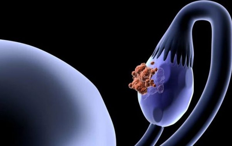 Aceste informații despre CANCERUL OVARIAN vă pot salva viața