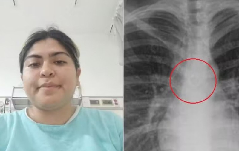 Cum s-a trezit o femeie cu un piercing în plămâni: „Nu mi-aș mai pune unul”