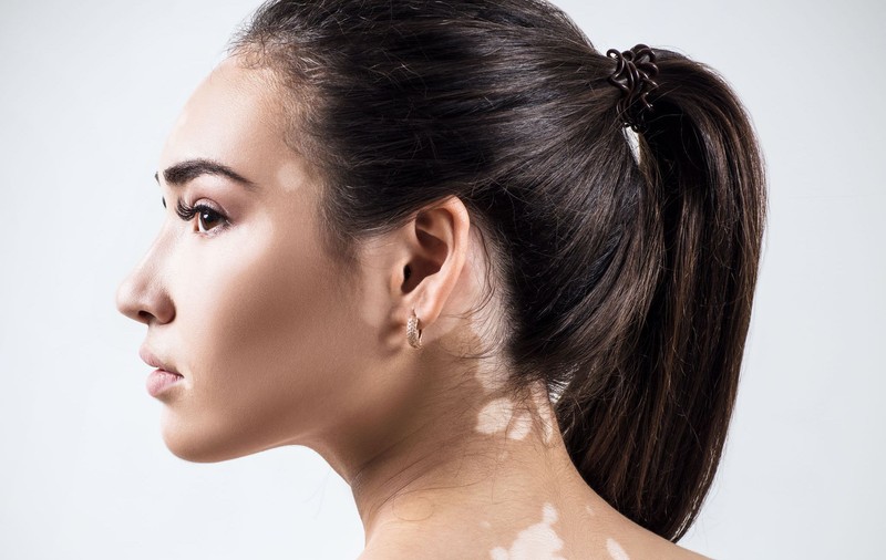 Vitiligo ar putea fi tratat cu UV și medicamente pentru artrită. Descoperire importantă în medicină