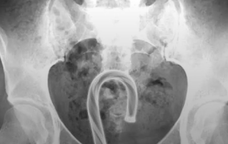 Ce descoperă medicii la radiografii: „Nu mai încercați acasă!”