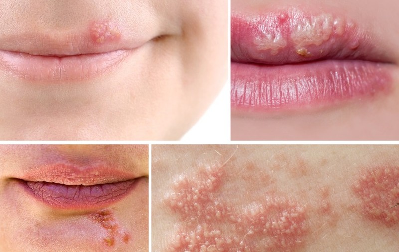 Cum îţi dai seama dacă ai herpes sau zona zoster