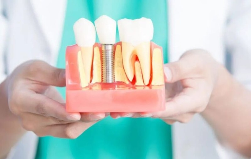Cât costă o proteză fixă cu 4 sau 6 implanturi? Tot ce trebuie să știi despre această soluție modernă de reconstrucție dentară