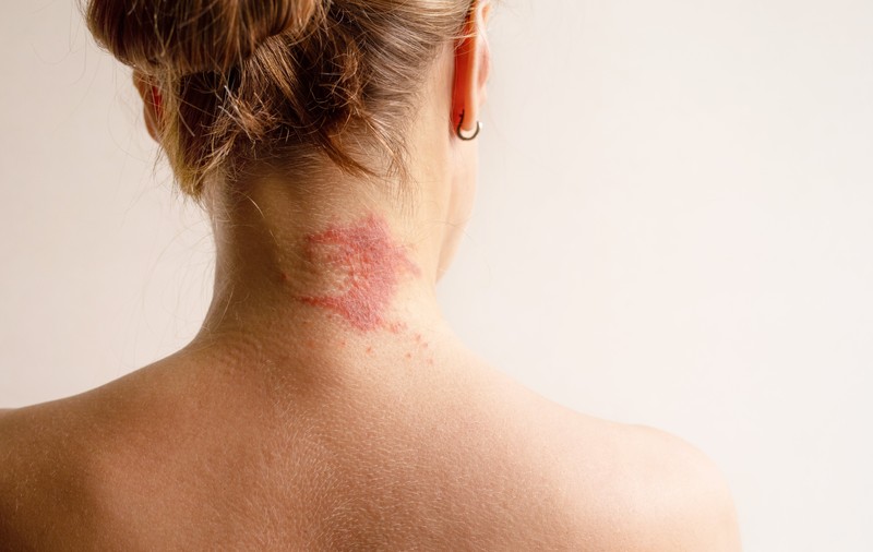 Dermatita este o boală contagioasă? Iată cum o tratăm