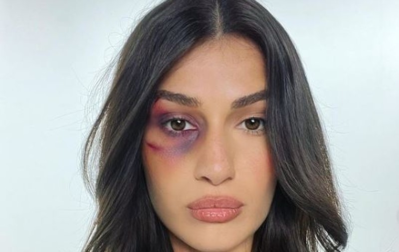 Alina Eremia și-a îngrijorat fanii, după ce a apărut cu un ochi vânăt. Artista a filmat pentru un nou videoclip: „Rănile se vindecă. Cicatricile rămân”