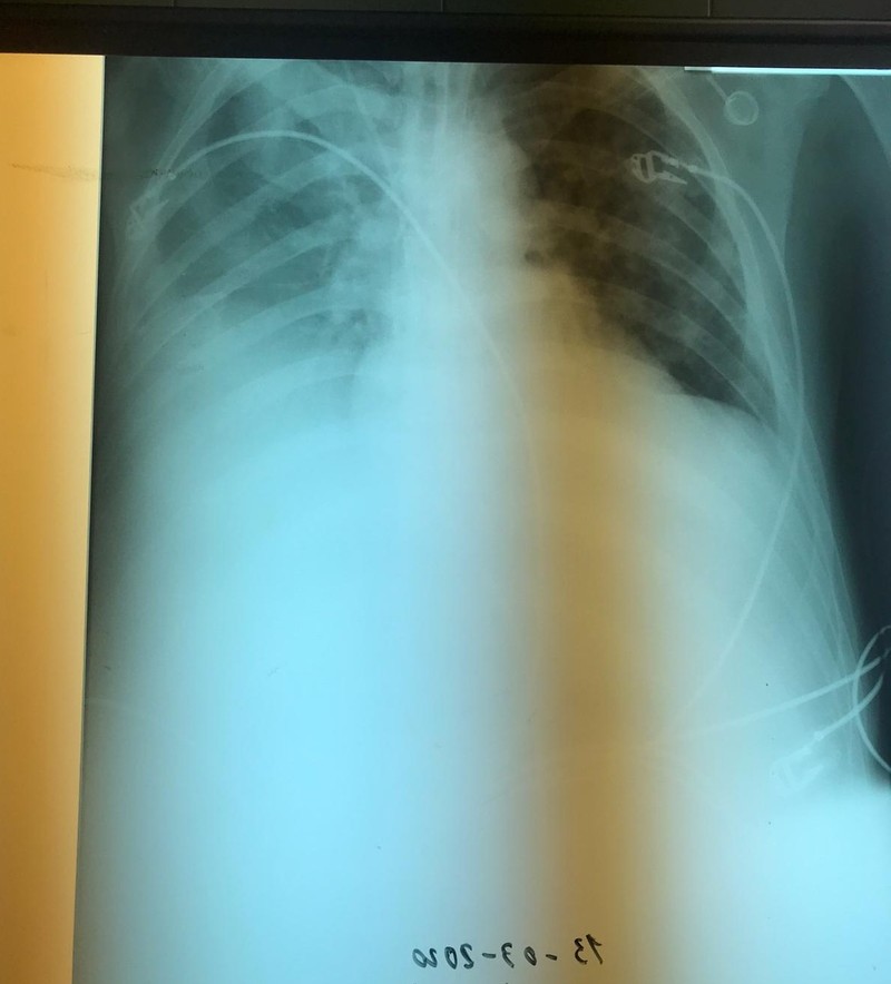 Plămânii pacientului de 40 de ani