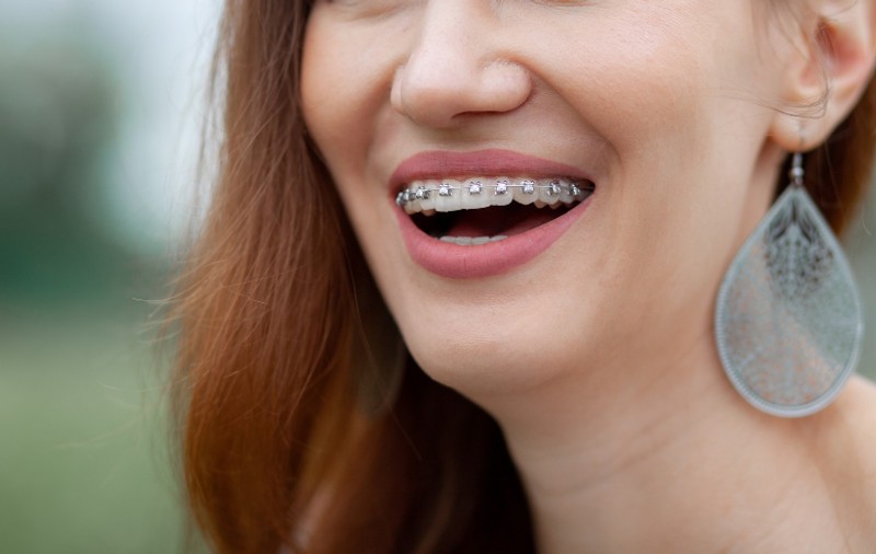Cât de eficientă este purtarea unui aparat dentar la adulți?