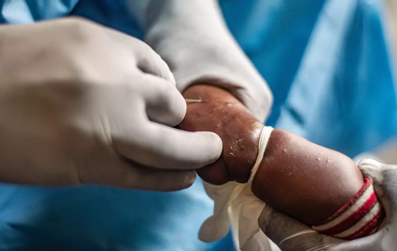 Mpox, cunoscută ca „variola maimuței”, nu este noul COVID, spune un oficial OMS