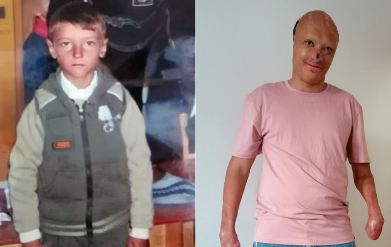 Exemplul de curaj al tânărului mutilat de un incendiu în copilărie. „Nu mă raportez la ce a fost, ci la ce pot construi mai departe”
