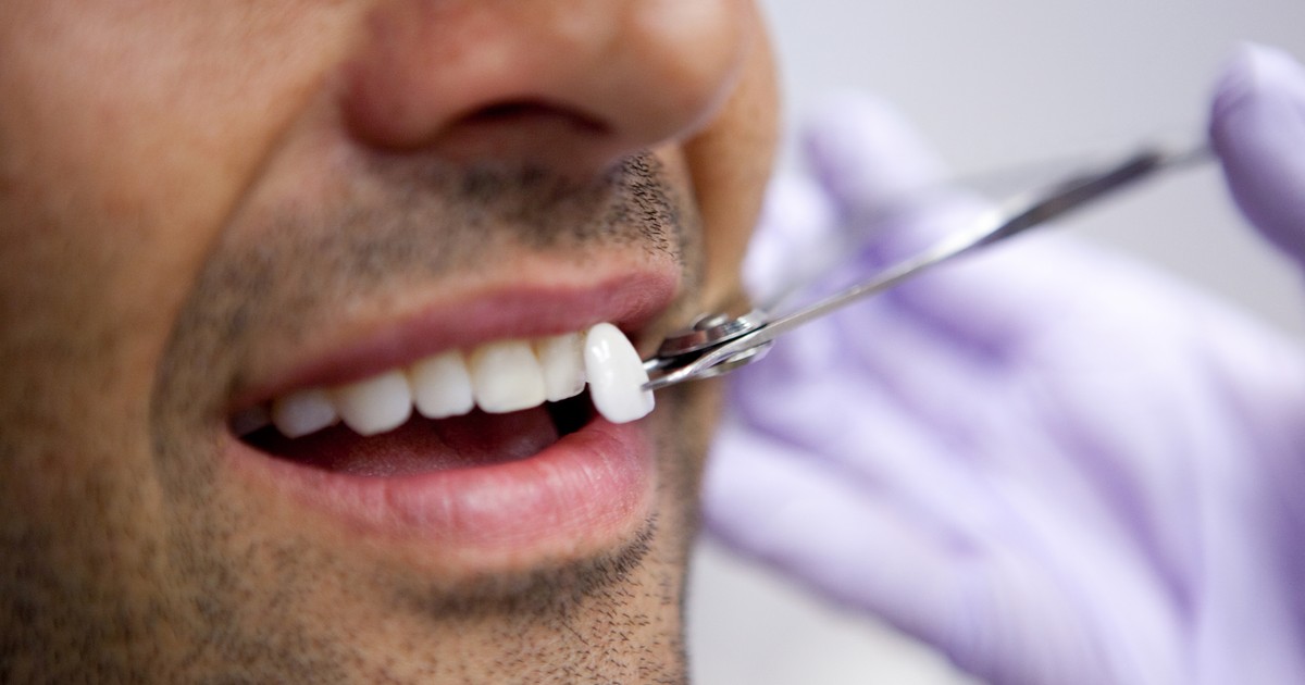 faţete dentare