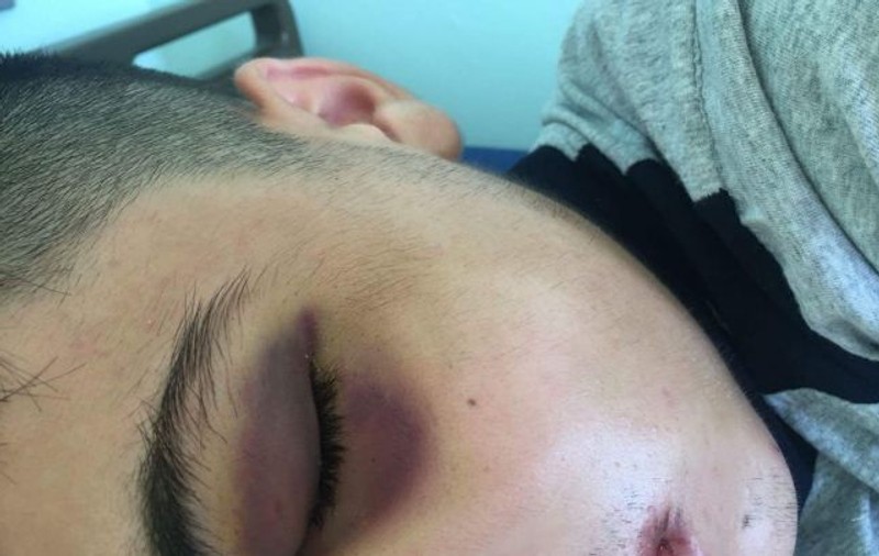 Elev din Craiova, bătut de un adolescent care practică boxul. A ajuns la spital după un singur pumn pentru că „se îmbracă prea frumos”