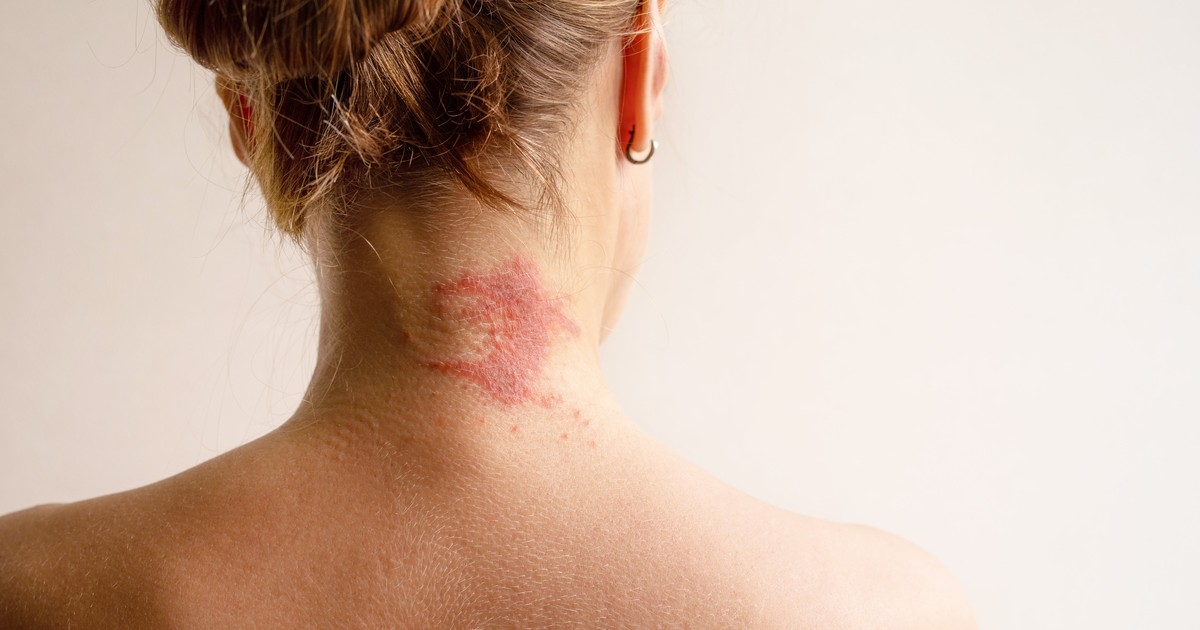 Femeie care sta cu statele, prezinta dermatita atopica pe gat