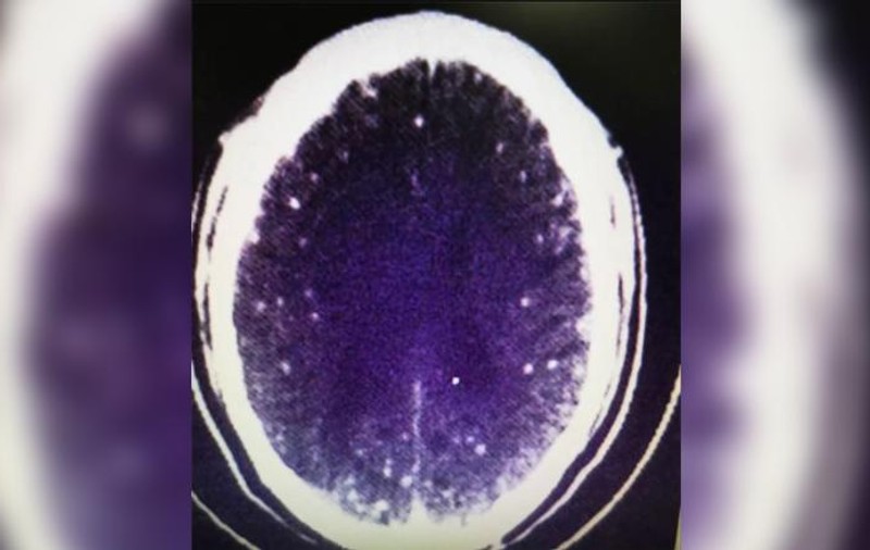 Un bărbat a început să aibă convulsii tot mai dese. Când a ajuns la spital, doctorii au rămas uimiți de ce au găsit în creierul respectivului
