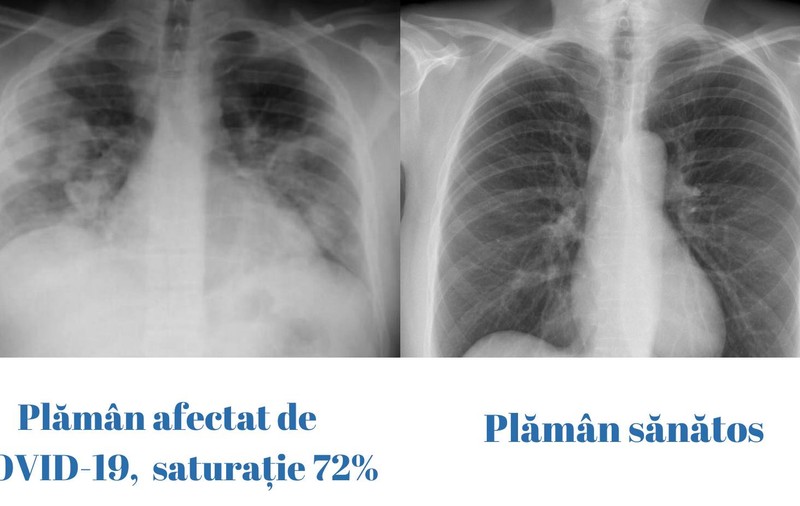 Cum arată un plămân afectat de COVID-19 faţă de un plămân sănătos. Avertismentul medicilor