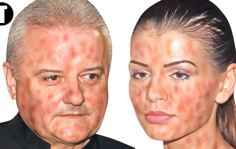 Columbeanu a lăsat să se înţeleagă că micuţa Irina a făcut rubeolă | Dacă vă umpleţi şi voi de bube?