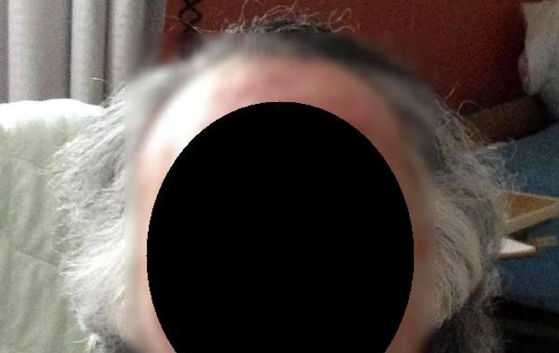 De NECREZUT! Uite cum arată după un an bărbatul al cărui chip a fost mâncat de canibal | FOTO ŞOCANT