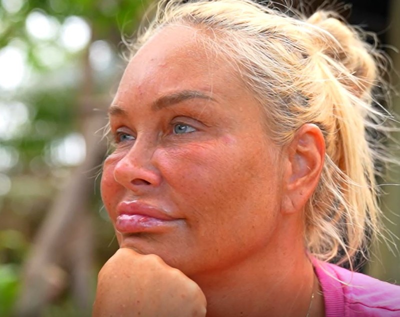 Ce s-a întâmplat cu fața Vicăi Blochina la Survivor România 2023. Motivul pentru care s-a umflat: „Aveam bube peste tot”