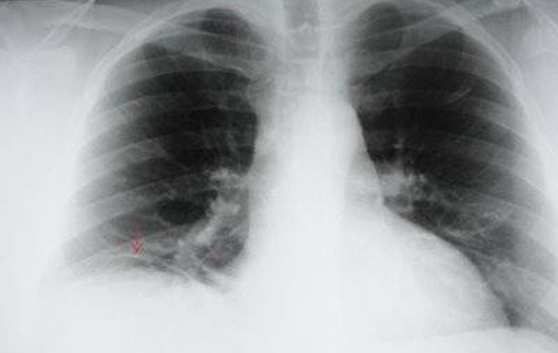 Fumatul ne vine de hac. Câţi români mor anual din cauza cancerului pulmonar?